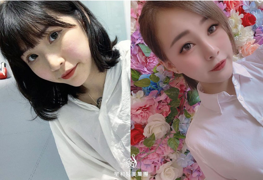【杏仁酸煥膚】星和診所/竹北醫美-還我透亮的肌膚-蛋娘、彭妍妍