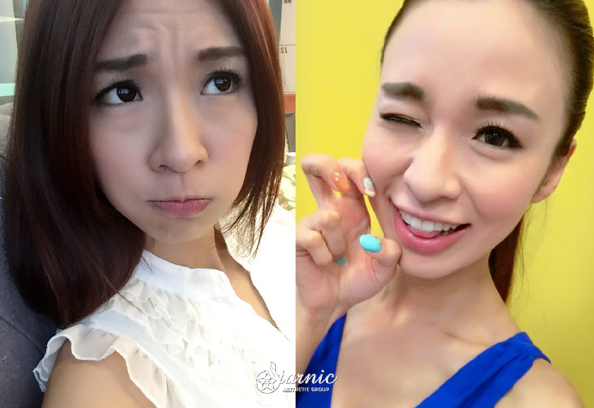 【微整抬頭紋】仁愛星和診所/東區醫美-表情豐富也不再怕有紋路囉！_小燕子 (上)