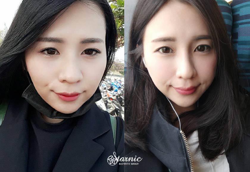 【玻尿酸、晶亮瓷】
