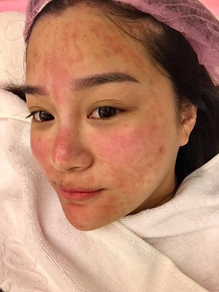 【淨膚雷射】認真覺得早上起床照鏡子都會嚇到，覺得皮膚變亮白了???