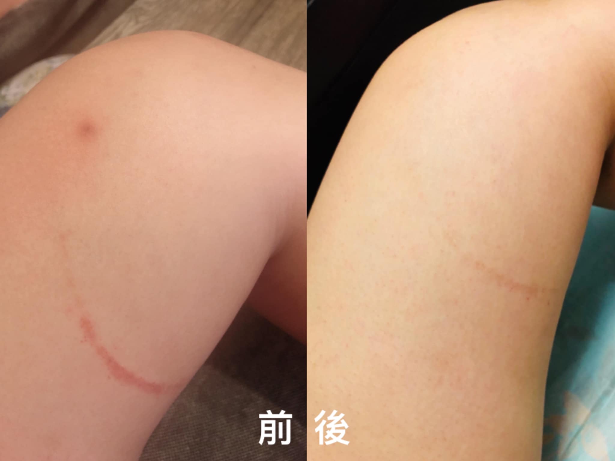 【淨膚雷射】