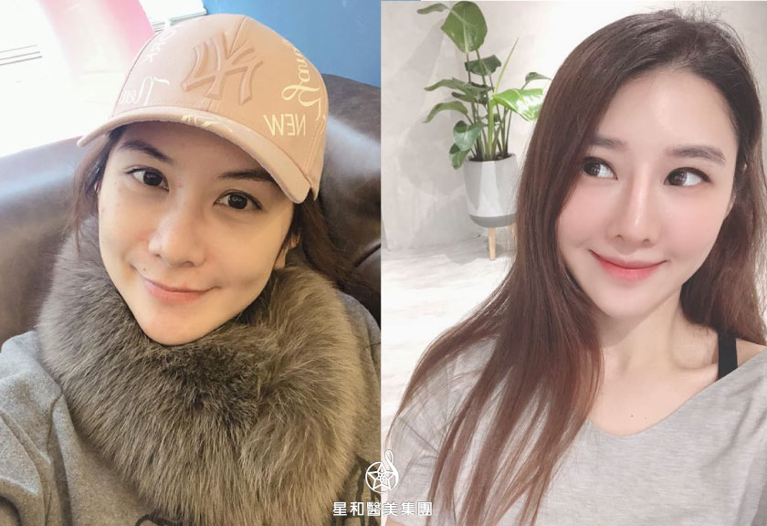 【杏仁酸煥膚】仁愛星和診所/東區醫美-體驗清爽亮白！投資自己永遠不嫌晚- Emily X Amèlie、湯若以