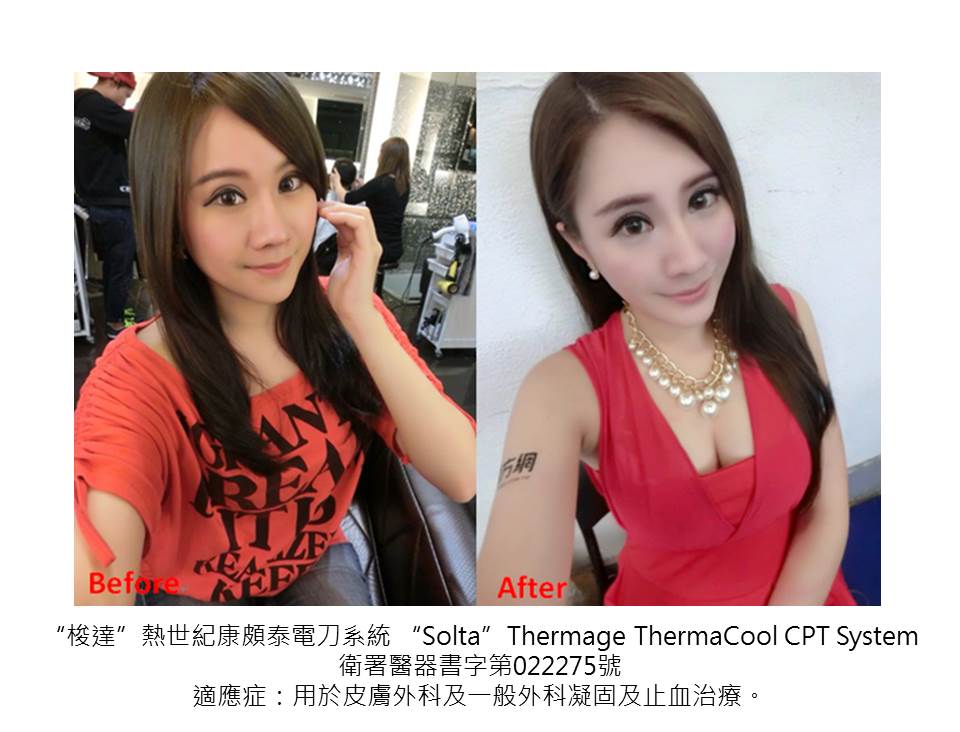 【電波拉皮+晶亮瓷填補下巴】星和診所（新竹市）-薛博今院長－最困擾肉肉臉＿貴婦