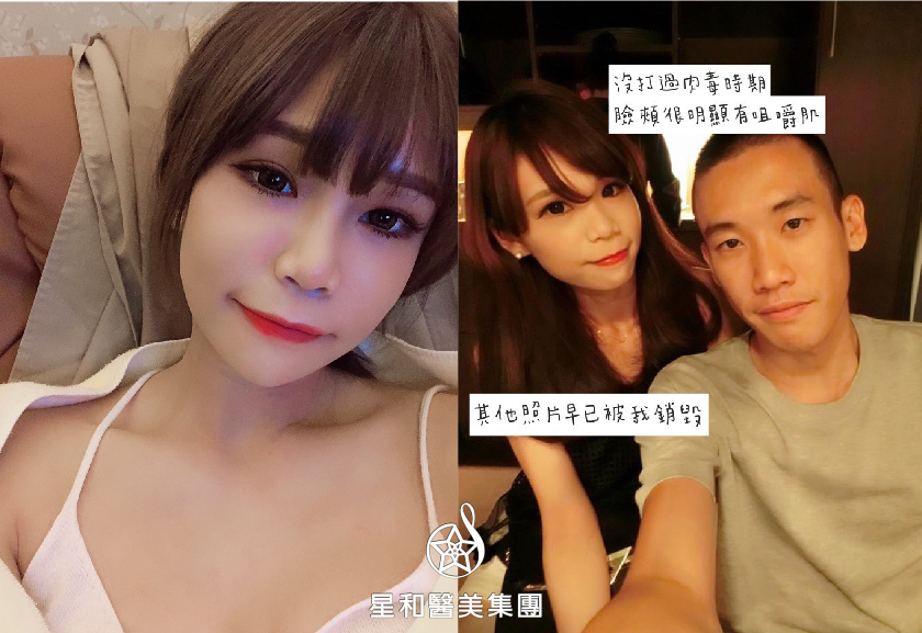 【瘦小臉注射】星和診所（新竹市）-王善民醫師-瘦小臉注射，開啟我人生康莊大道的一把鑰匙-RicoleHo小雞 (中)