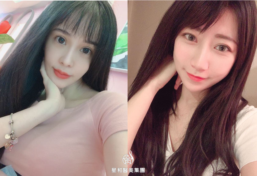 【杏仁酸煥膚】星和診所/北車醫美-追求素顏美，煥膚照過來！-魏庭瑄、比特