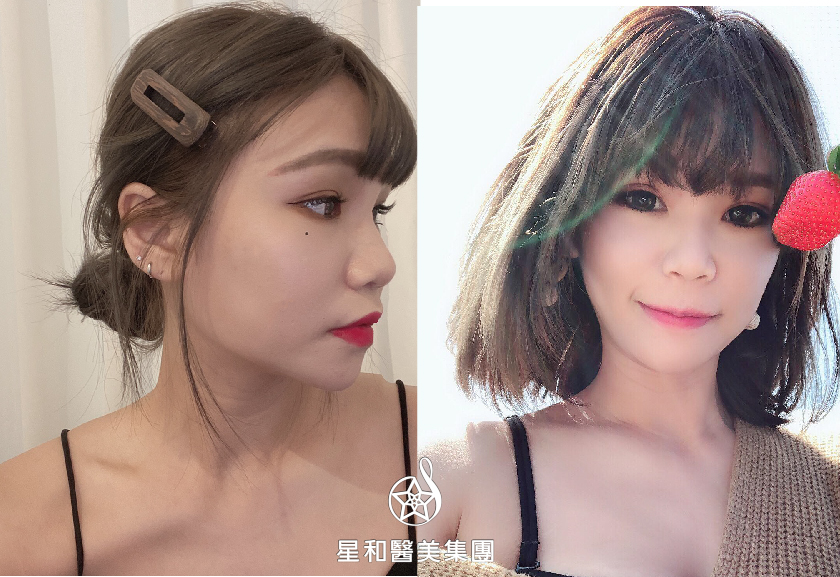 【瘦小臉注射】星和診所（新竹市）-王善民醫師-瘦小臉注射，開啟我人生康莊大道的一把鑰匙-RicoleHo小雞 (下)