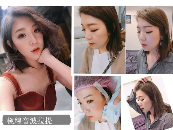【Ulthera極線音波拉提】星和診所（新竹市）-薛博今醫師—讓我跟萬年大小臉說掰掰！拍照終於不再喬角度！-艾比小姐 (上)