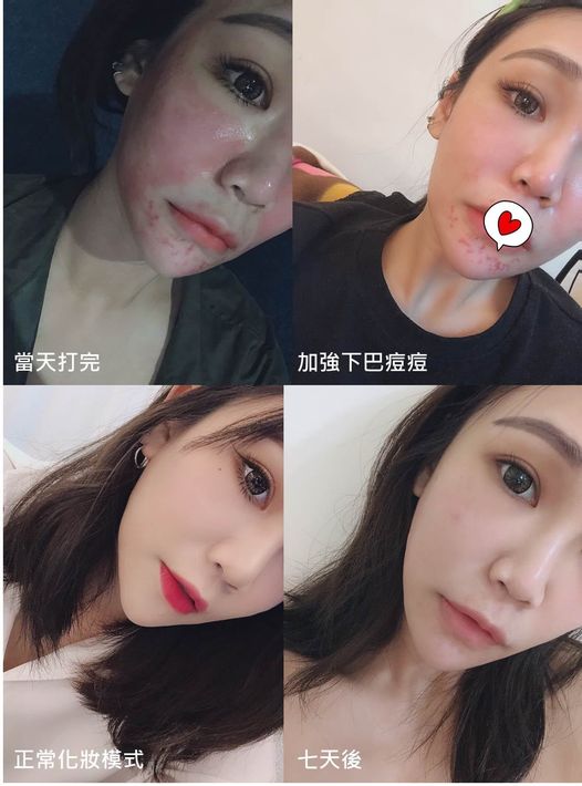 【皮秒雷射】看了保你一生平安