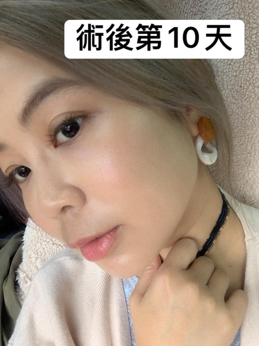 【皮秒雷射】星采皮膚專科診所 (古亭)-叫我要美就要忍 換來一張超有面子的臉啊_愛比妞。親子純粹玩