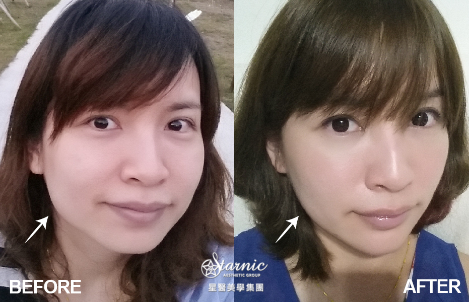 【公主玻尿酸補淚溝+晶亮瓷補下巴】星和診所（新竹市）-陳明如醫師-雙管齊下拯救媽媽的疲態~~(下)