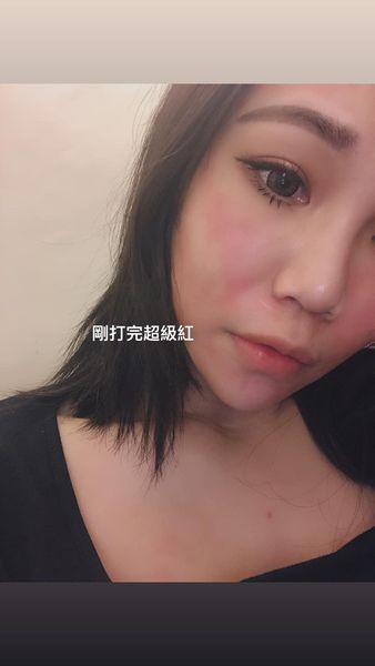【淨膚雷射】太推薦大家去打皮秒了！！