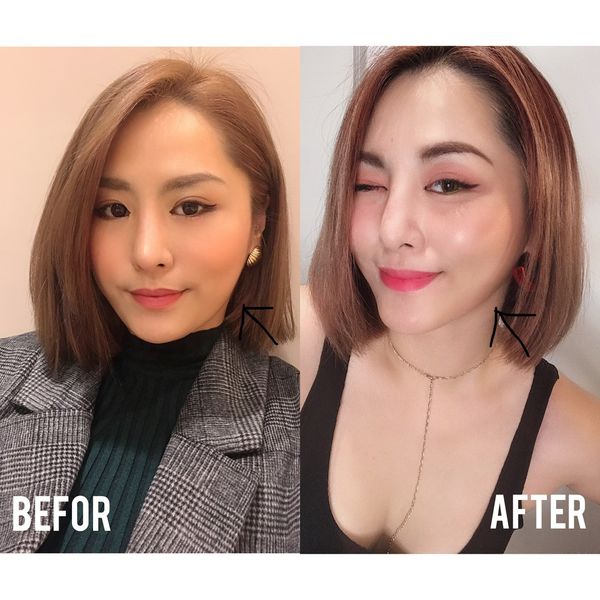  【肉毒瘦小臉】星采整形外科整所(大安)-消滅又肥又壯的咀嚼肌～救回我的小臉！-DEMI (上)