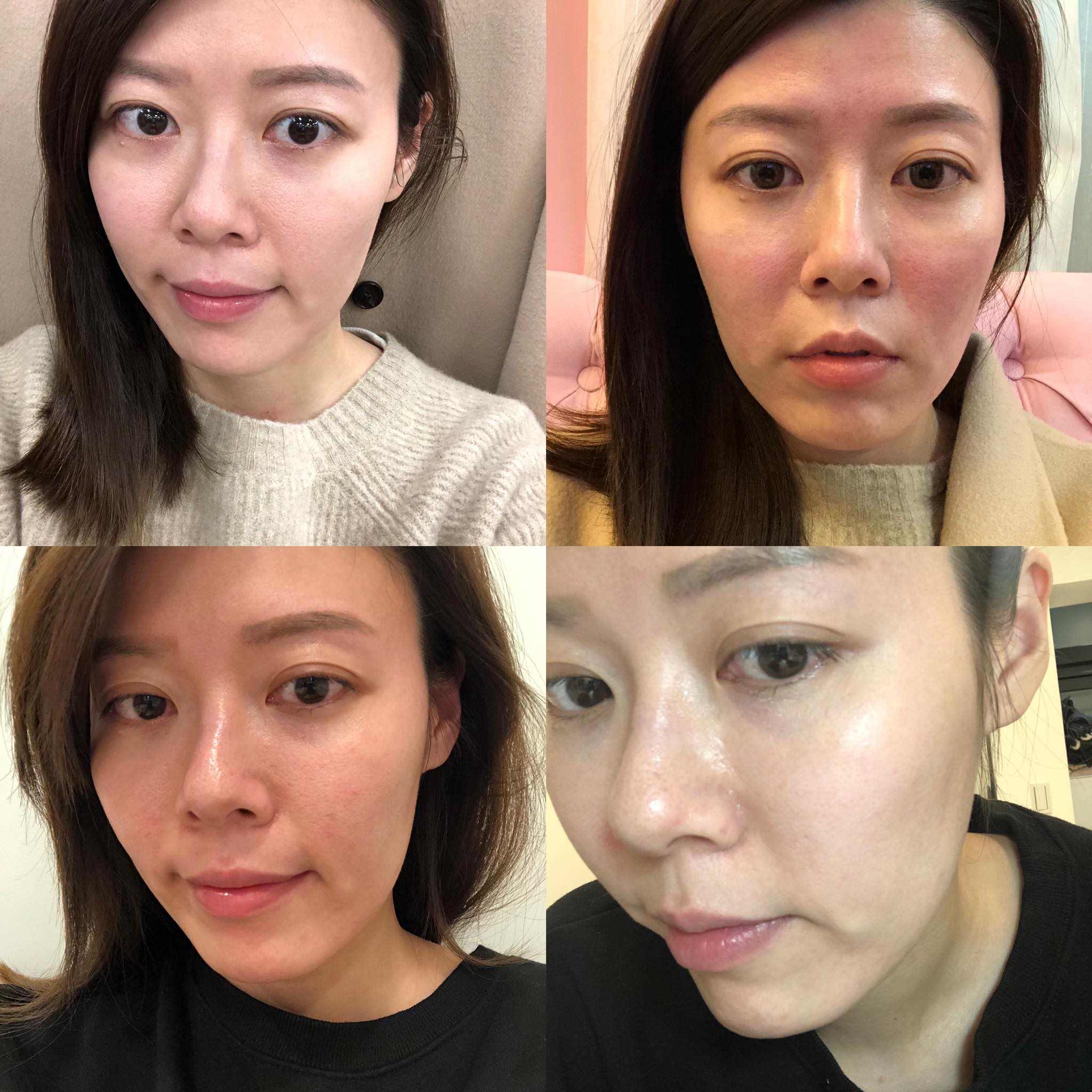 【皮秒雷射】台北星和診所 -趁現在每天都要戴口罩 偷偷整形都沒人會發現呢！_HALO ERIKA