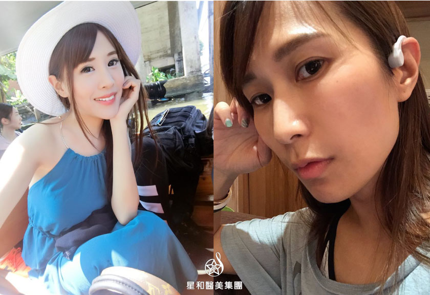 【玻尿酸】星采皮膚專科診所(古亭)-拯救臉凹苦命兒- Hi chia恰女孩、Taobaby 濤寶日記