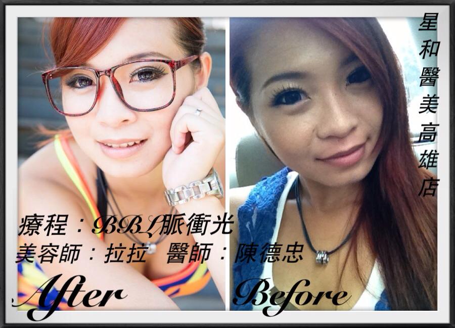 【彩衝光】星和診所-台南市-從小開始遺傳性的雀斑就跟著我到現在_凌育司