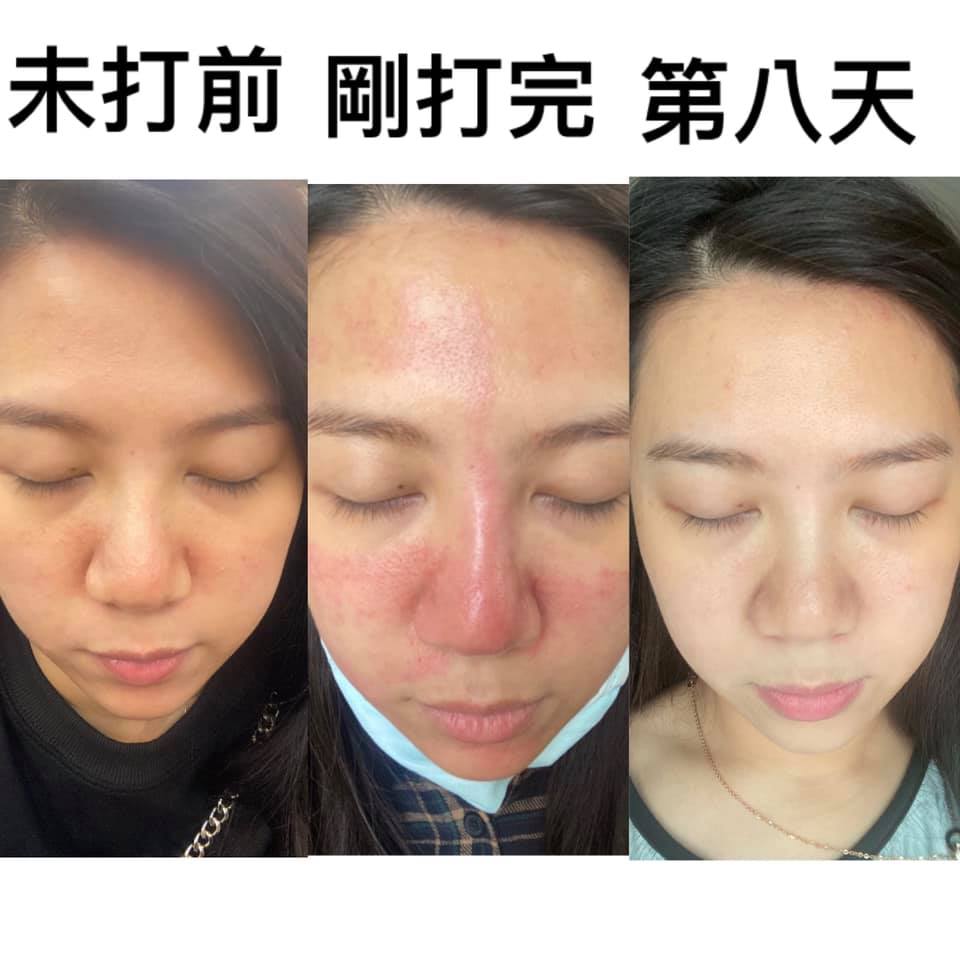 【皮秒雷射】星和診所-高雄市 劉勇甄醫師-擊退臉上斑點的問題！_吳于琪