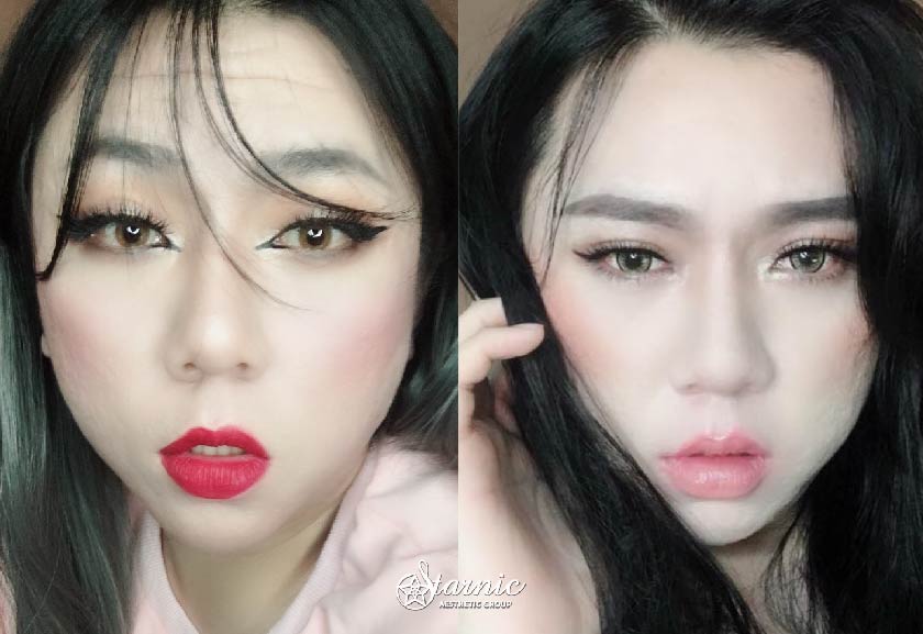 【微整除皺+玻尿酸填補抬頭紋】