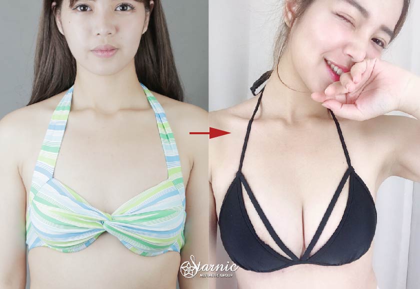 【大腿環狀抽脂+補胸】逆時整型外科診所(大安)-邱大睿醫師-擺脫討厭壯壯腿的心願-Fiona