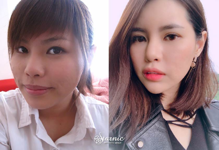 【瘦小臉注射+玻尿酸豐額/淚溝/蘋果肌+晶亮瓷夫妻宮/太陽穴】古亭星和診所-王善民醫師-賞我一個精緻的混血臉，技術真的很重要!!(下)!-Reva