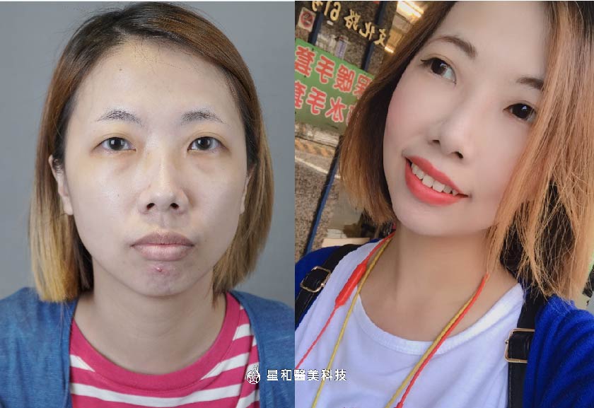 【玻尿酸】古亭星和診所-王善民醫師-好臉色！好人緣！擺脫無精打采的衰衰臉(上)-Ann