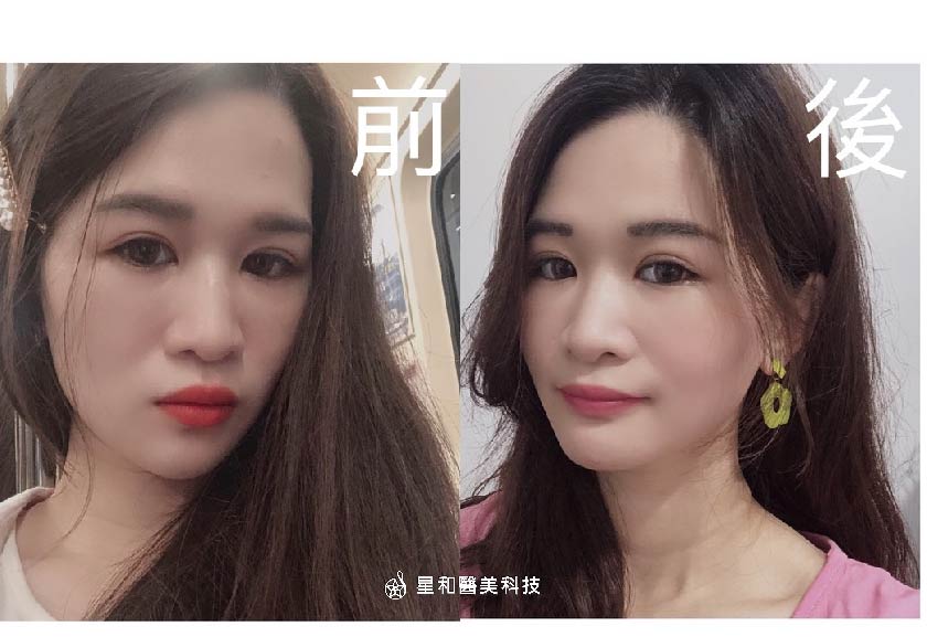 【Sculptra 舒顏萃+玻尿酸】星和診所/北車醫美-方穎涵醫師-偷偷逆齡的小秘密(下)-Maya