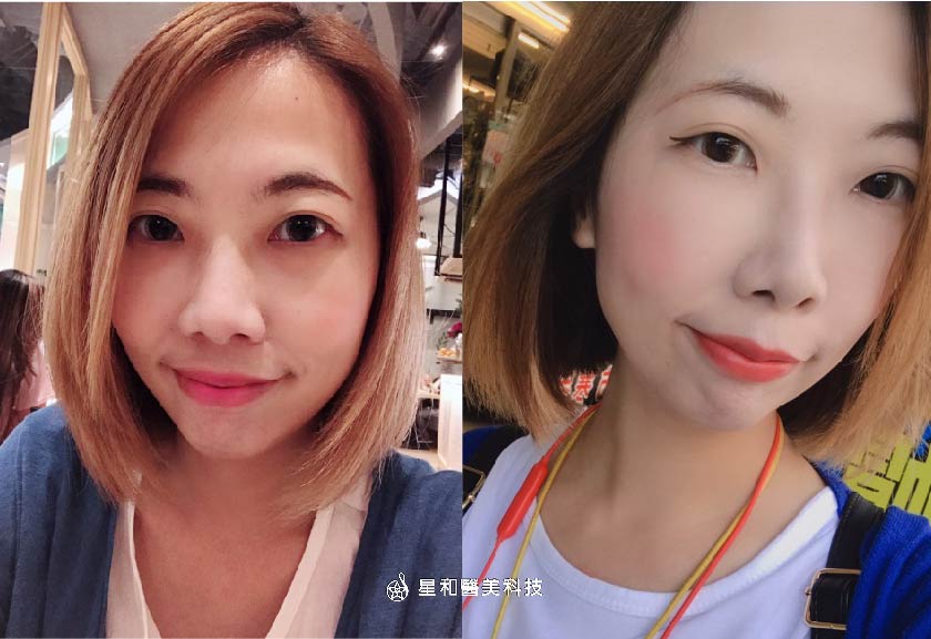 【玻尿酸】古亭星和診所-王善民醫師-好臉色！好人緣！擺脫無精打采的衰衰臉(下)-Ann