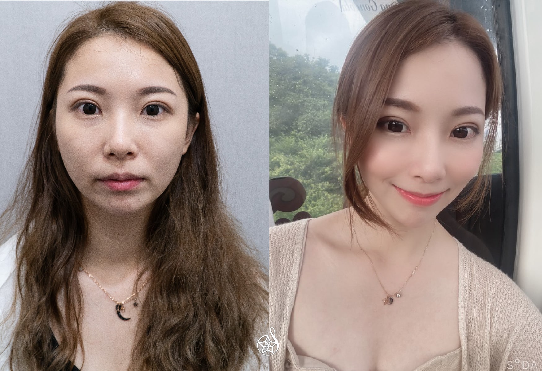 【女神動態玻尿酸】古亭星和診所-王善民醫師-提升氣色，讓顏值加分的秘密(上)-Rita