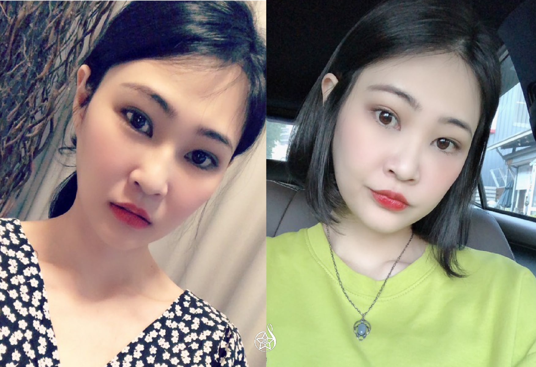 【玻尿酸豐額】星和診所（新竹）-黃伊寧醫師-一點點改變，讓自信大加分(上)-Celine