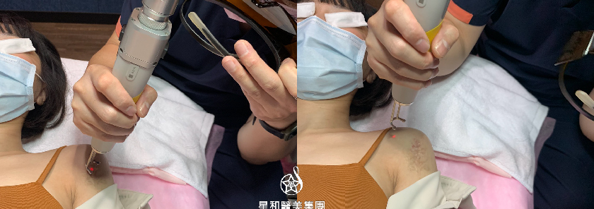 【皮秒雷射刺青】星和診所（新竹）-錯位的刺青，就讓皮秒雷射幫我去除(下)-Rainie蕊尼