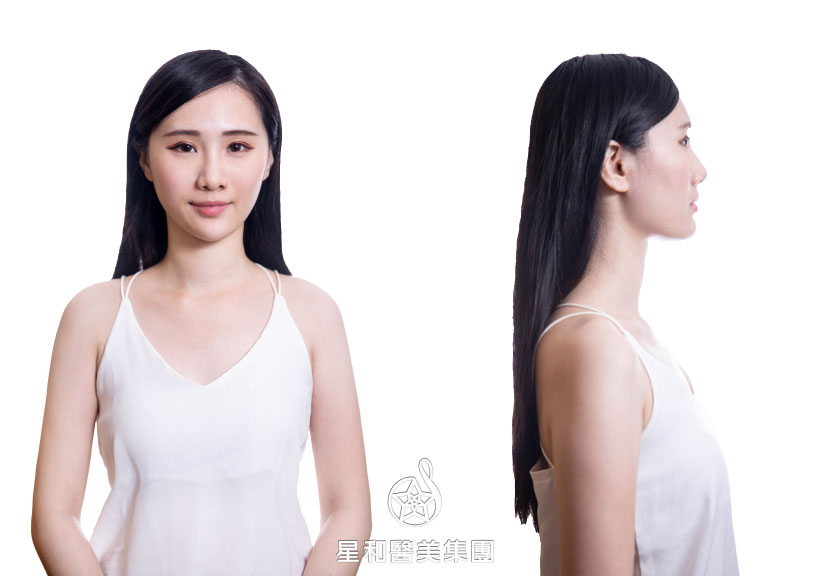 【Motiva魔滴隆乳】星采整形外科診所(大安)-邱大睿醫師-投資自己，是最值得的一件事-小米 (中)