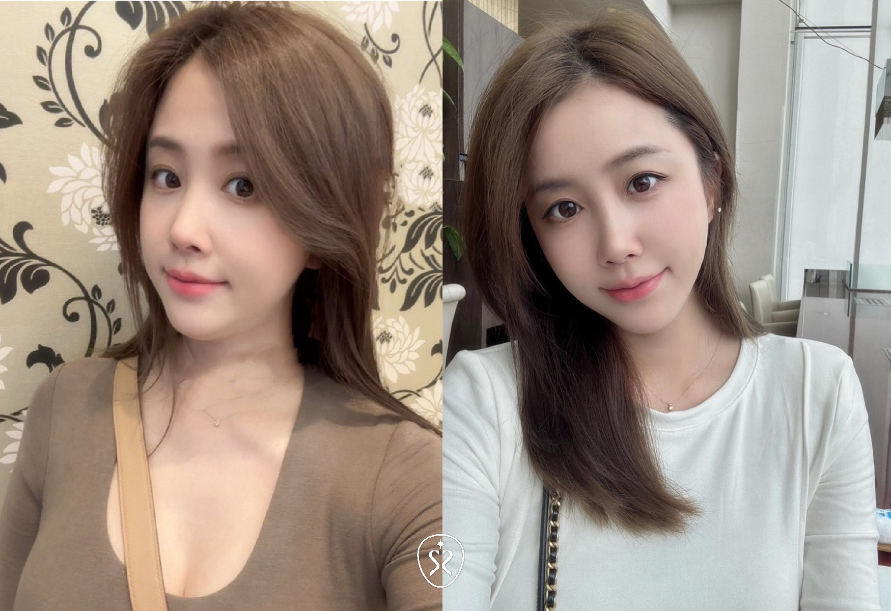 【容脂注射劑 Ronkyla（改善雙下巴）】