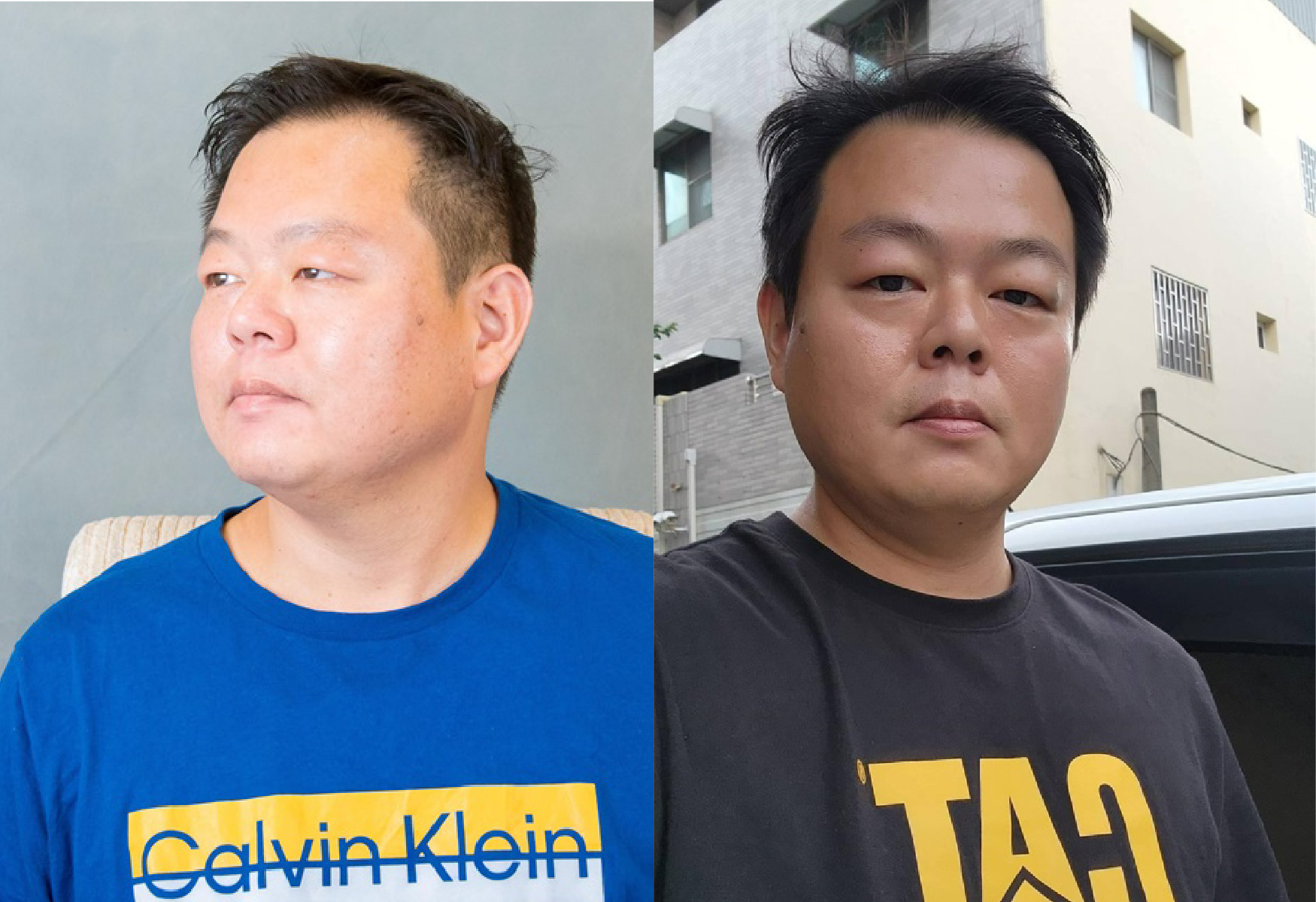 【容脂注射劑 Ronkyla（改善雙下巴）】