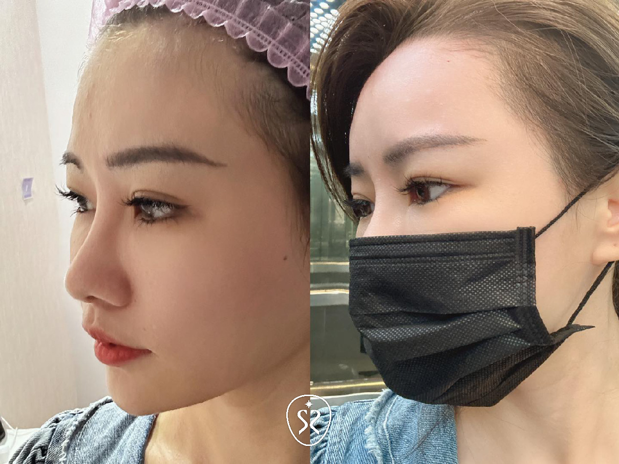 【玻尿酸】