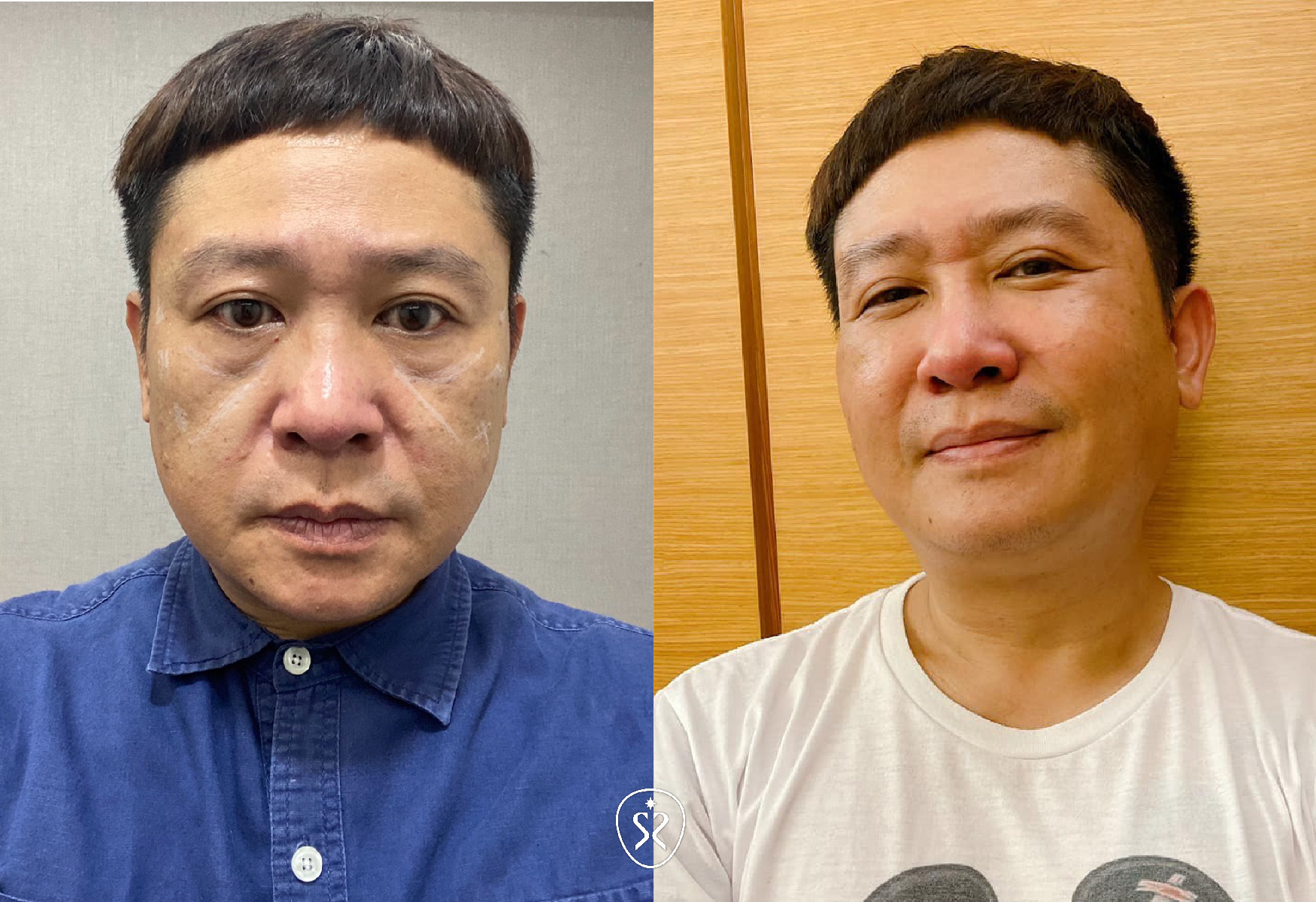 【玻尿酸+晶亮瓷】