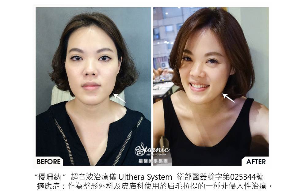 【極線音波拉提】星和診所/台南醫美 院長鄭玉貞醫師—拒踏入輕熟女行列之還我少女輪廓線