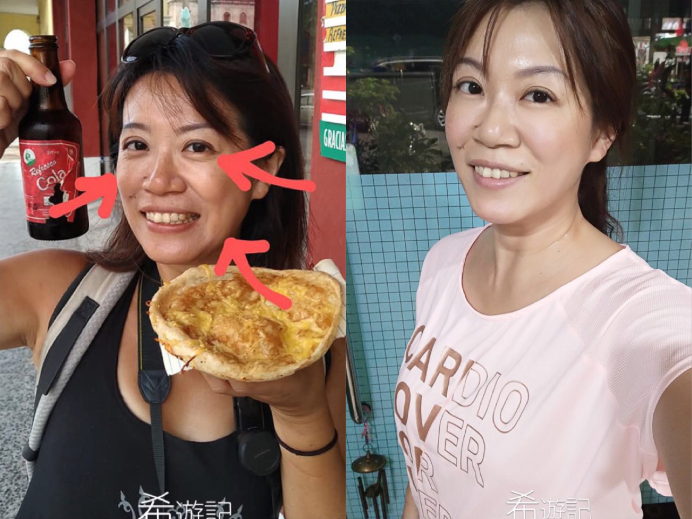 【肉毒除皺+皮秒雷射】