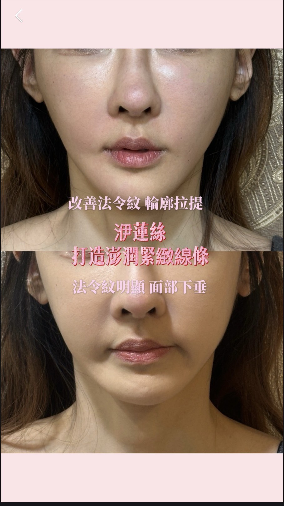 【洢蓮絲】古亭星和診所-30歲後膠原蛋白掉的速度，比存款還快-Ashley
