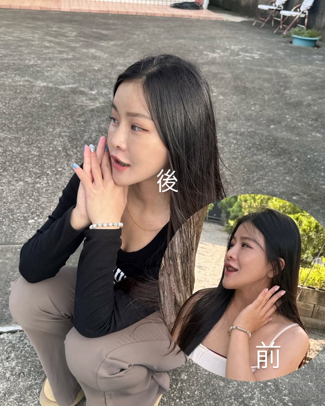 【玻尿酸】星和診所（桃園）-薛博今醫師-法令紋真的超級顯老(•ˋ _ ˊ•) 尤其是戴牙套更明顯 真的不知道我之前在堅持什麼-周詠晴