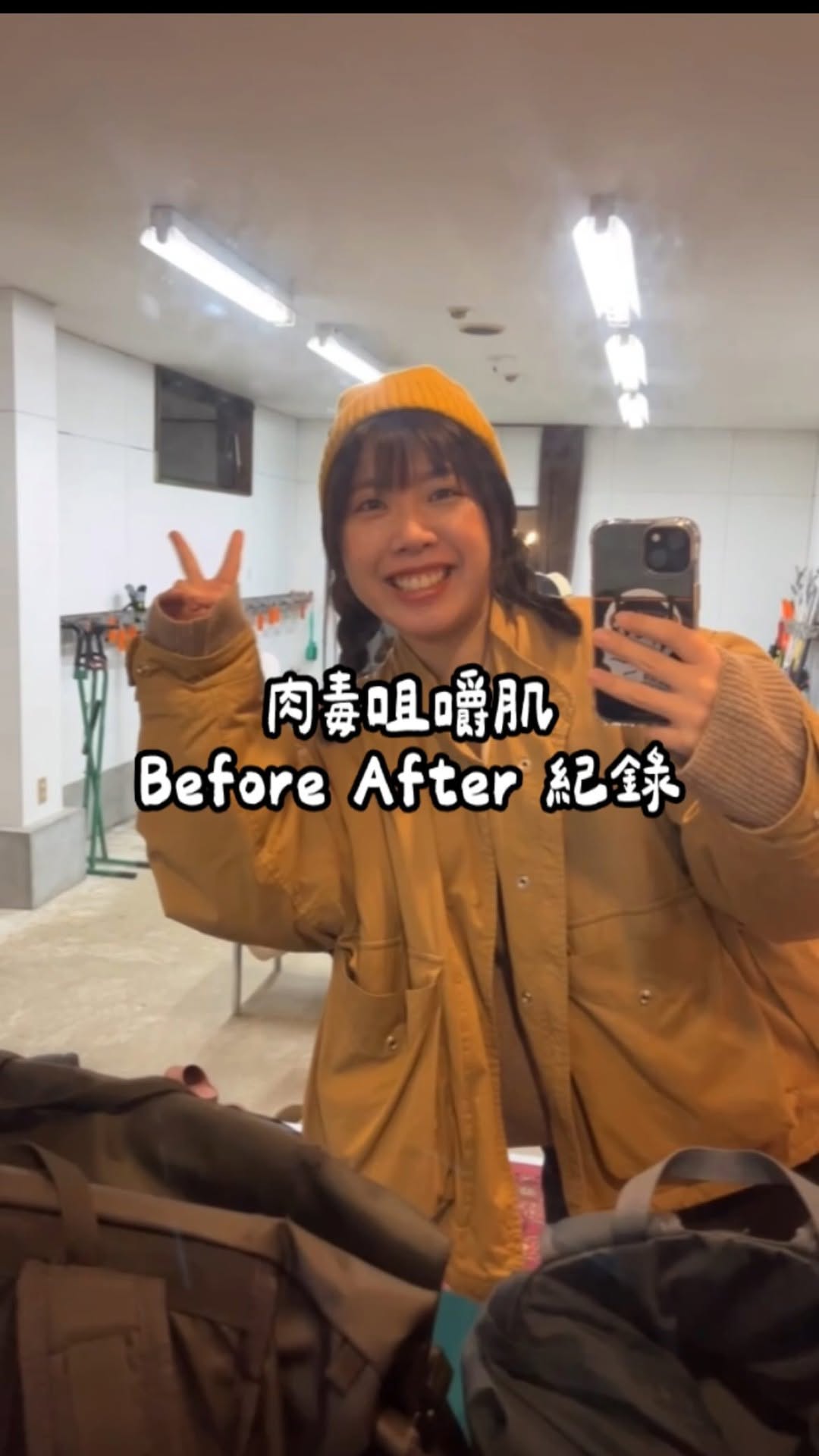 【肉毒桿菌注射】