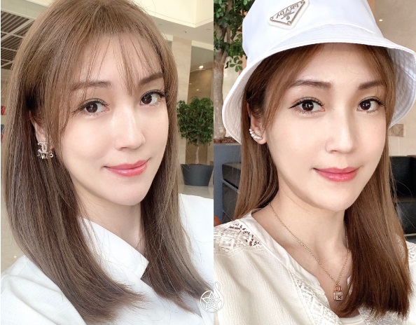 【玻尿酸】星和診所（新竹）-只要幾分鐘，就能擁有澎潤有朝氣的臉頰(上)-Serina甄詒