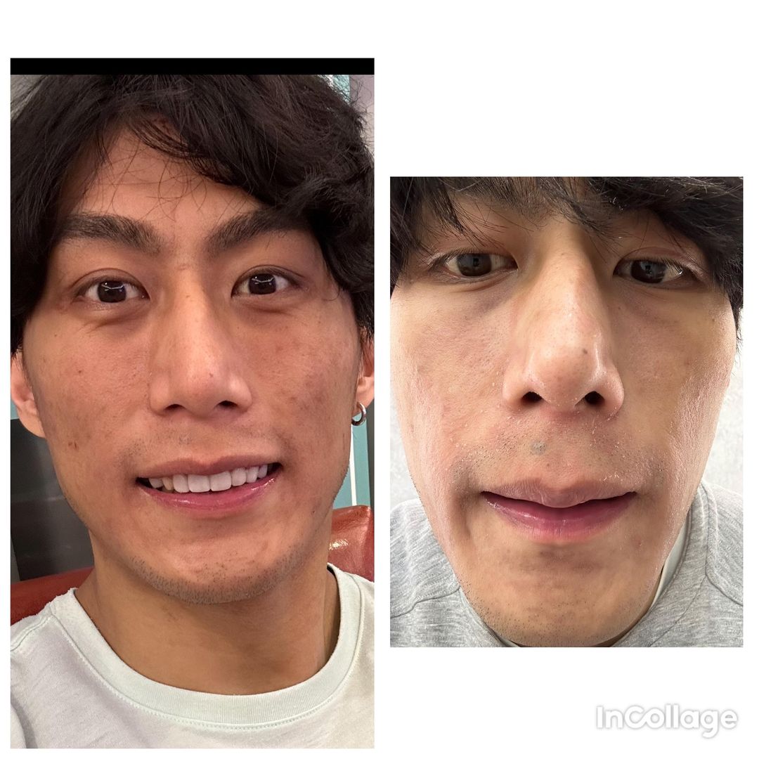 【皮秒雷射】