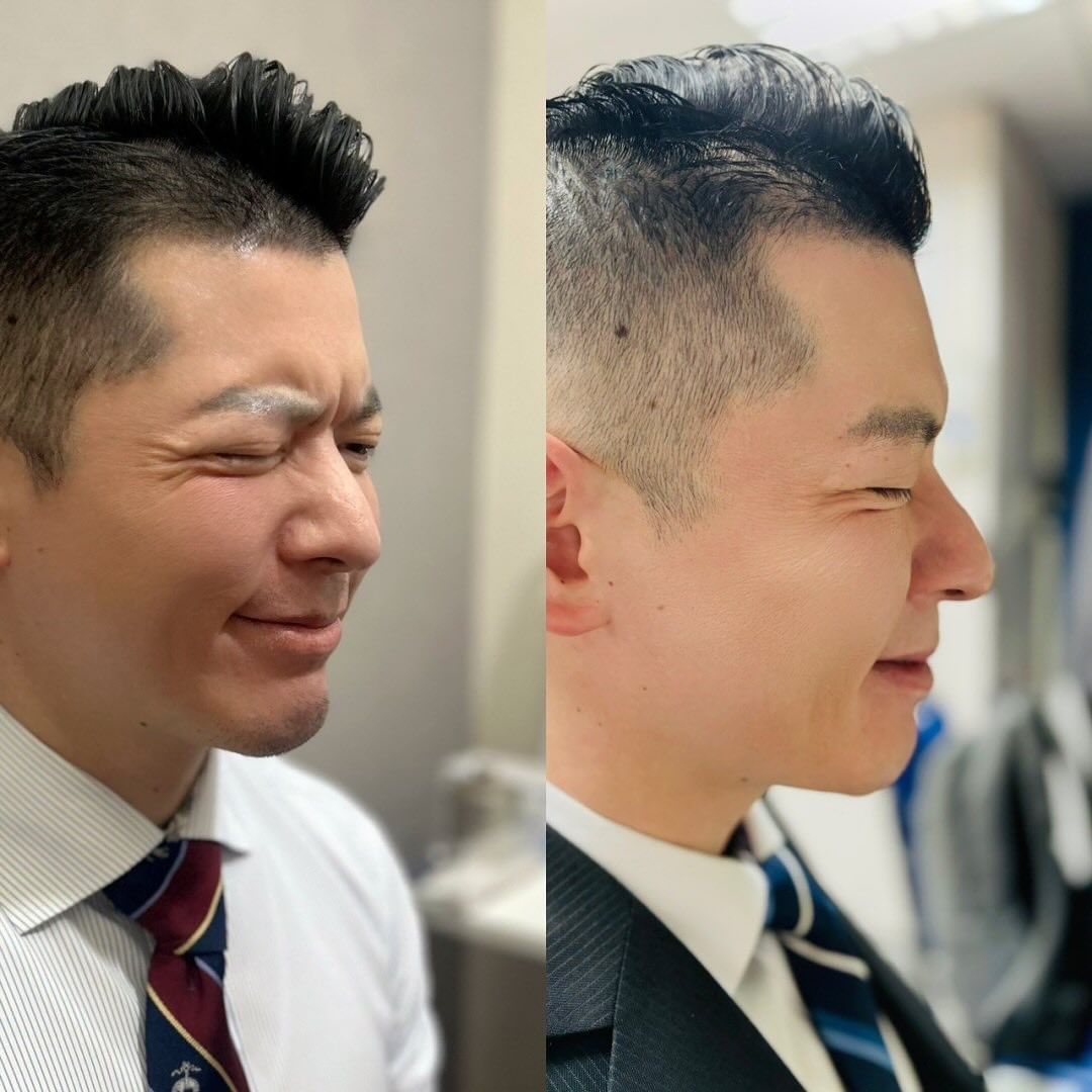 肉毒除皺