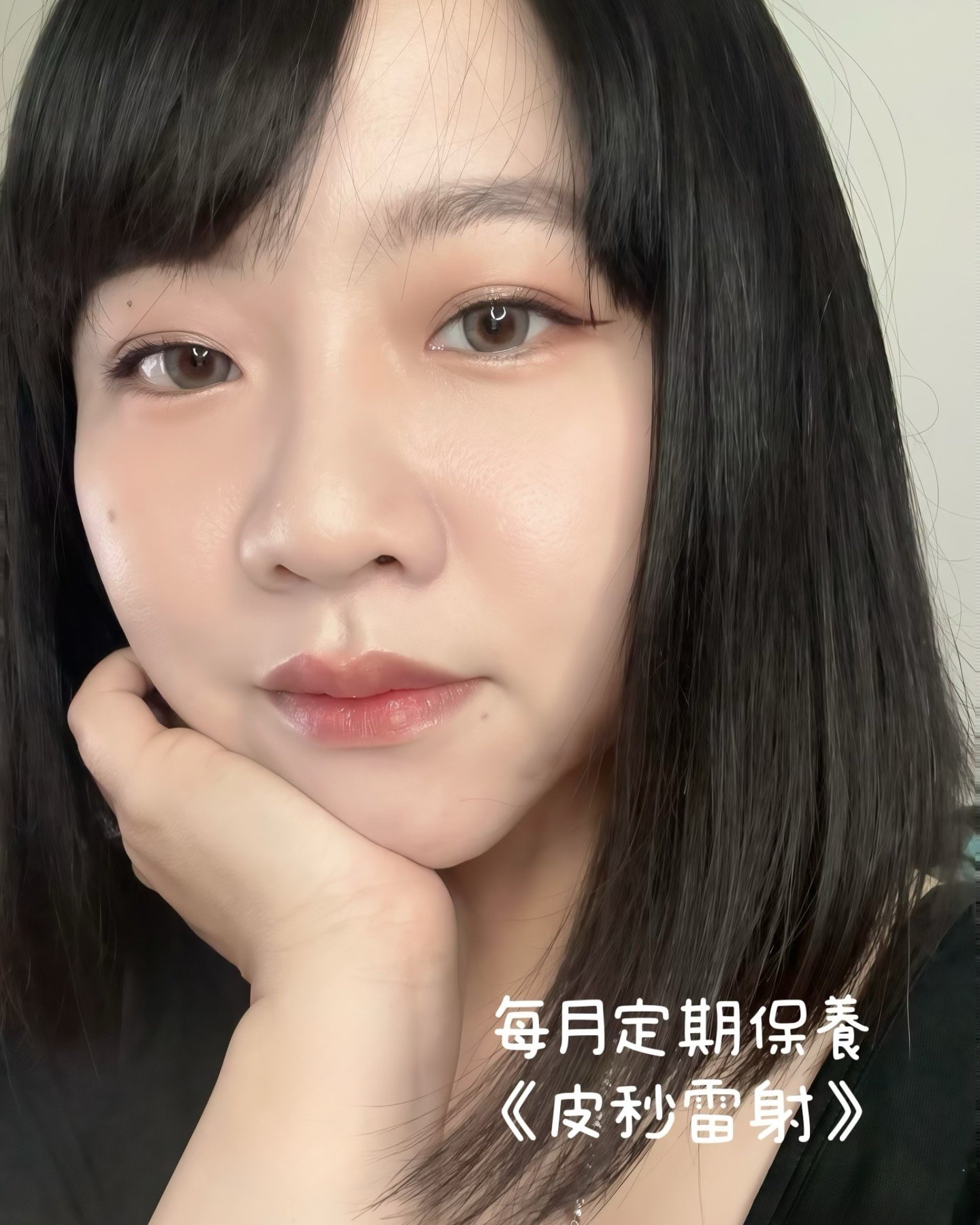 【皮秒雷射】