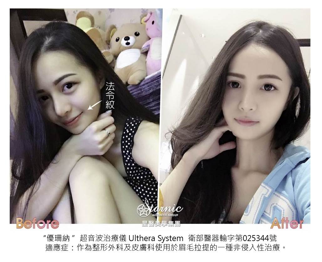 【極線音波拉提】星和診所/高雄醫美-小資女省錢秘技~鬆弛肉臉變年經實記！