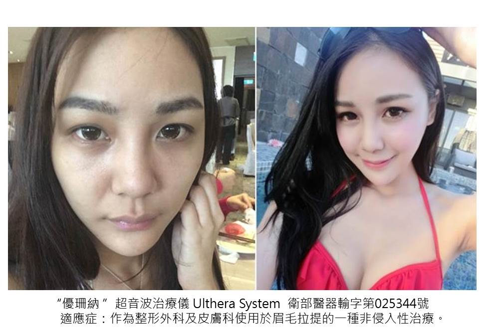 【極線音波拉提】不想變成黃臉婆? 極線音波拉提對付老垂臉！ - 星采星和醫美