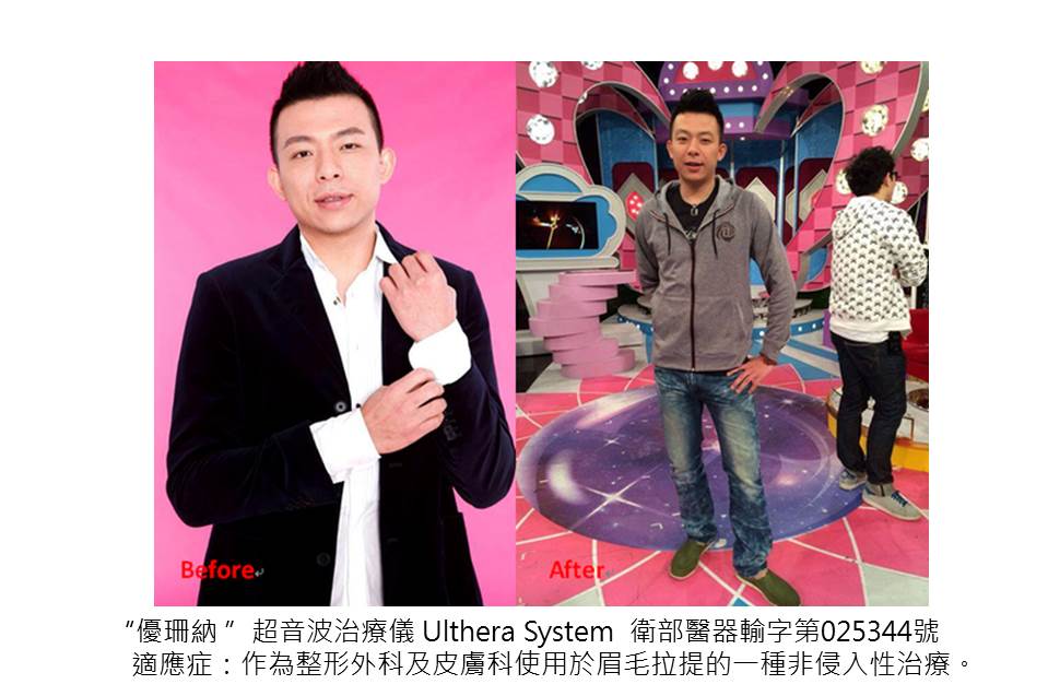 【Ulthera極線超音波拉提】星采整形外科診所(大安)/葉姿辰醫師－極線音波拉提還我陽光帥帥臉_林群峰