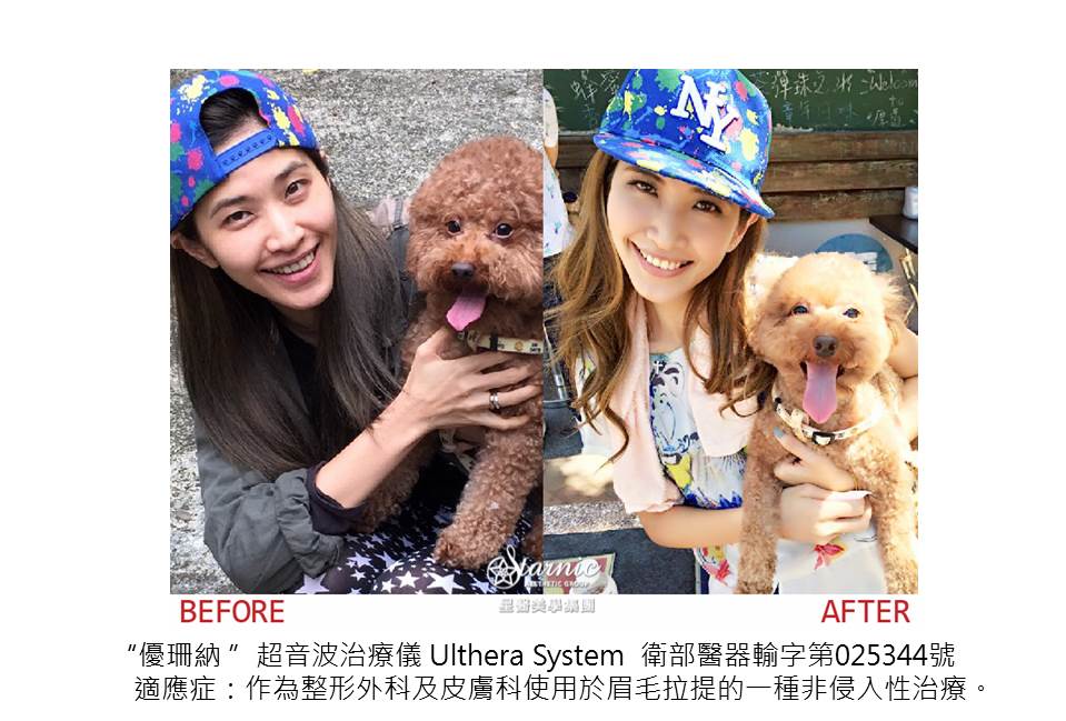 【Ultherapy極線音波拉提】