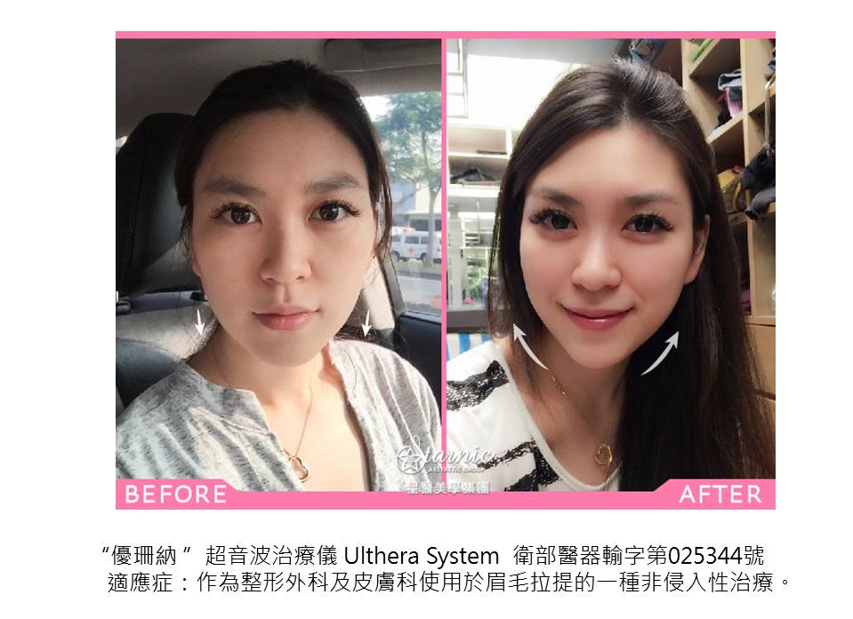 【Ulthera極線音波拉提