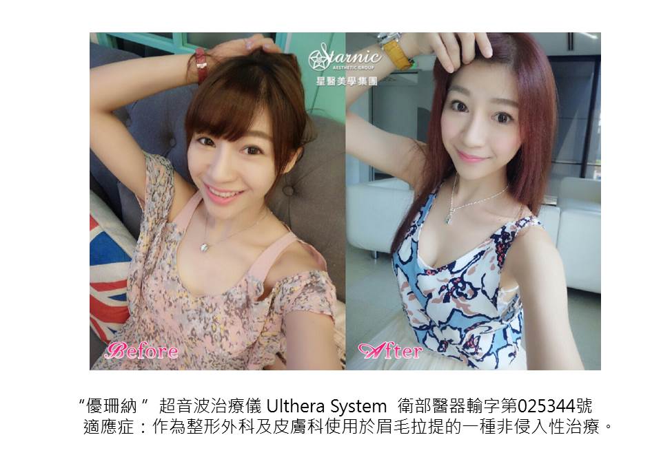 【Ultherapy 極線音波拉提】