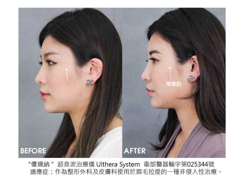 【Ultherapy極線音波拉提+電波拉皮+玻尿酸填補額頭、淚溝和蘋果肌】星采整形外科診所(大安)-拒絕臉蛋任歲月擺佈，美女絕對不能輕易說認老＿阿眯頭(下)
